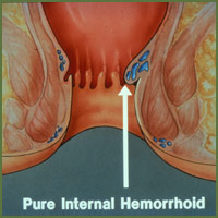 Hemorrhoid surgeons surgery Tampa. Irritable Bowel Disease treatments.